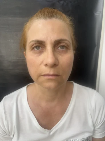 поставяне на ботокс