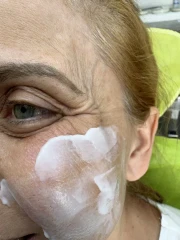 поставяне на ботокс поставяне на ботокс