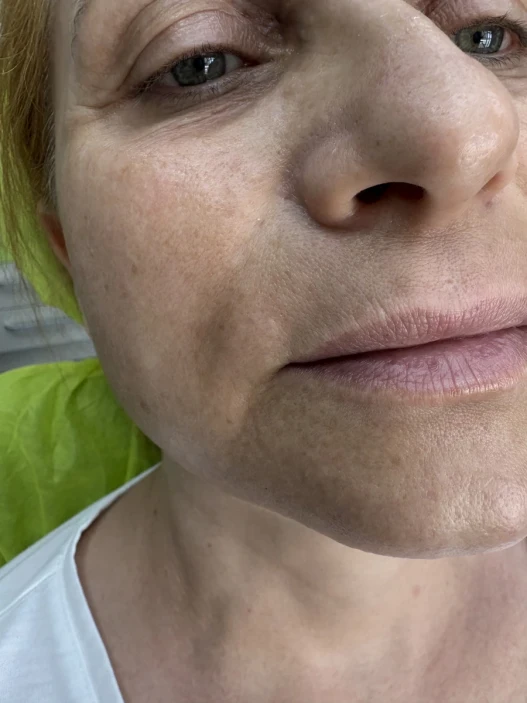 поставяне на ботокс поставяне на ботокс