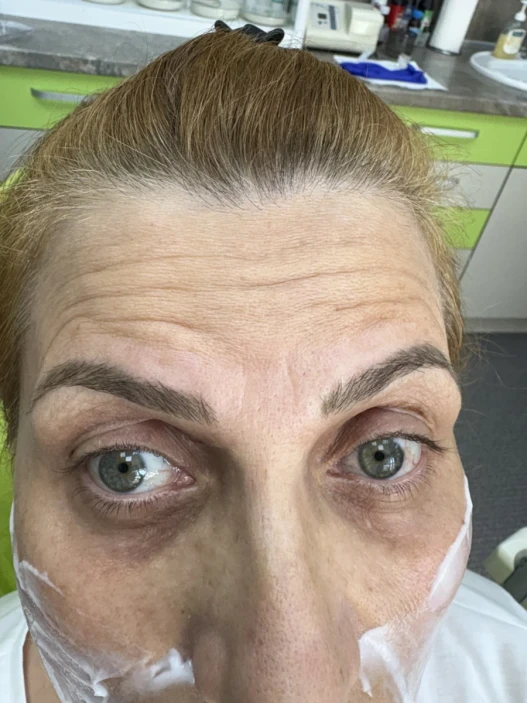 поставяне на ботокс поставяне на ботокс