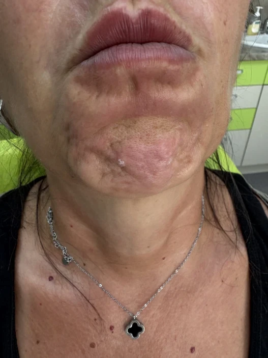 поставяне на ботокс