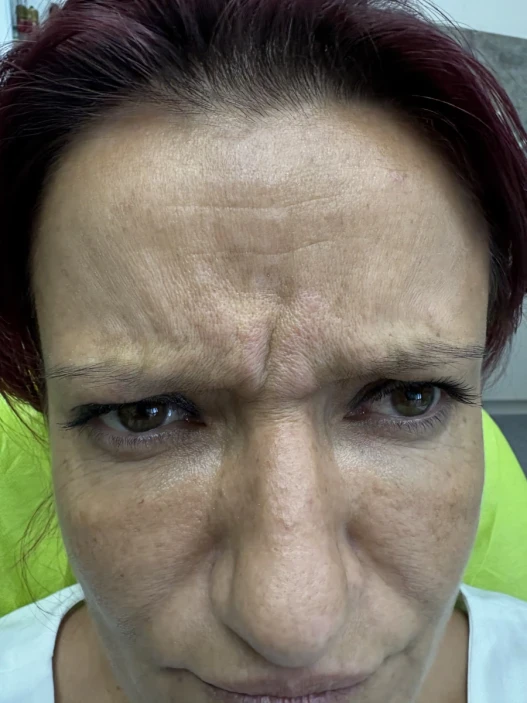 поставяне на ботокс