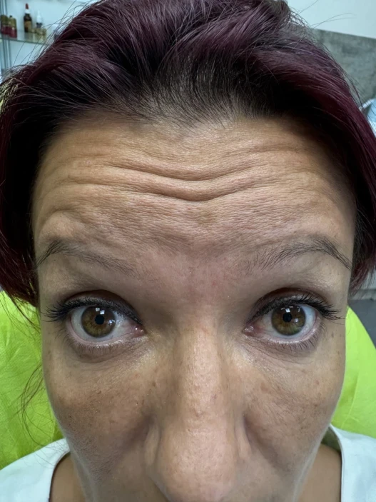 поставяне на ботокс поставяне на ботокс