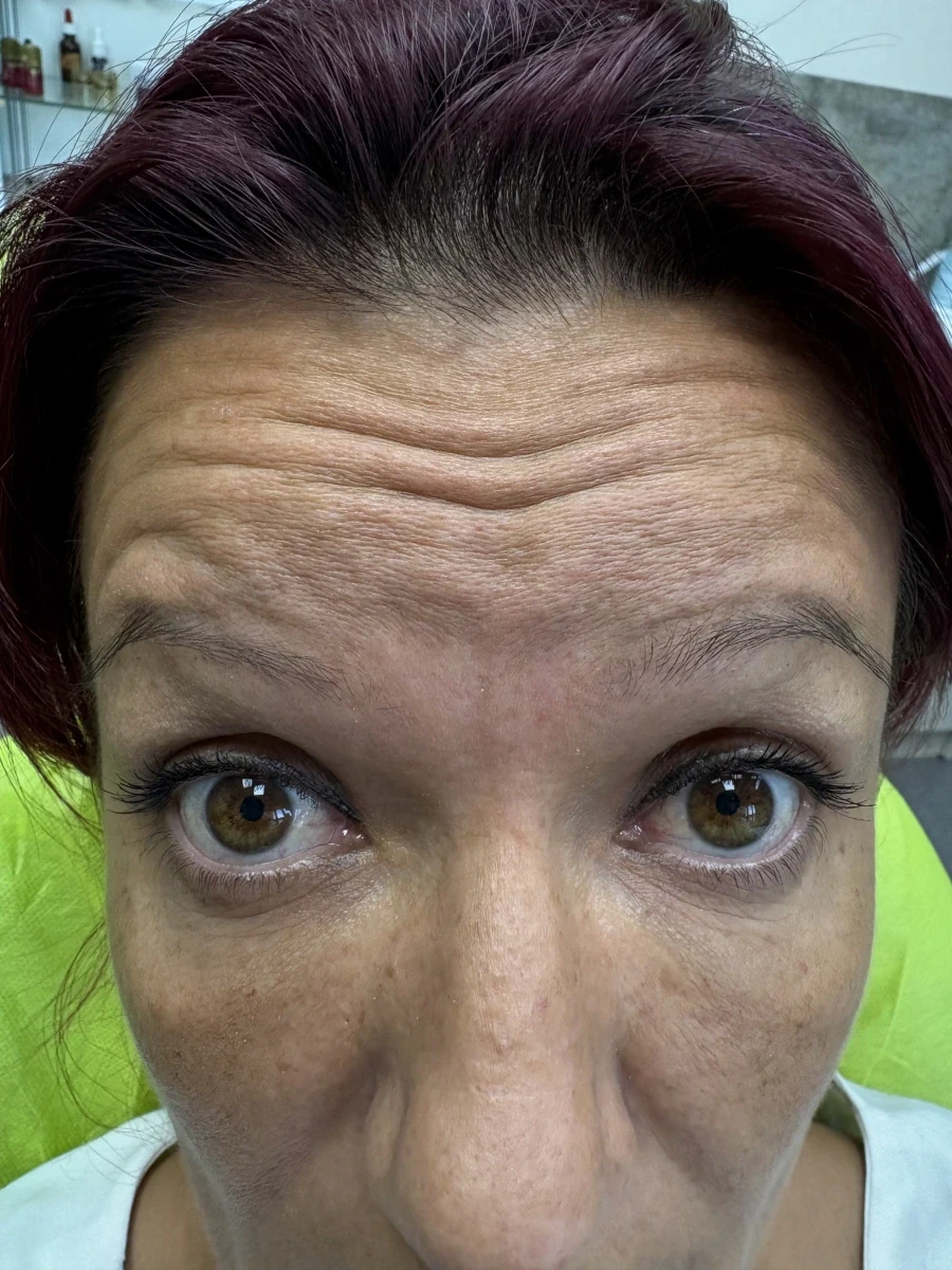 поставяне на ботокс - Reservation.Studio