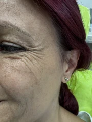 поставяне на ботокс поставяне на ботокс