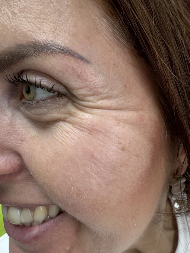 поставяне на ботокс - Reservation.Studio поставяне на ботокс - Reservation.Studio