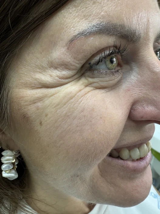 поставяне на ботокс