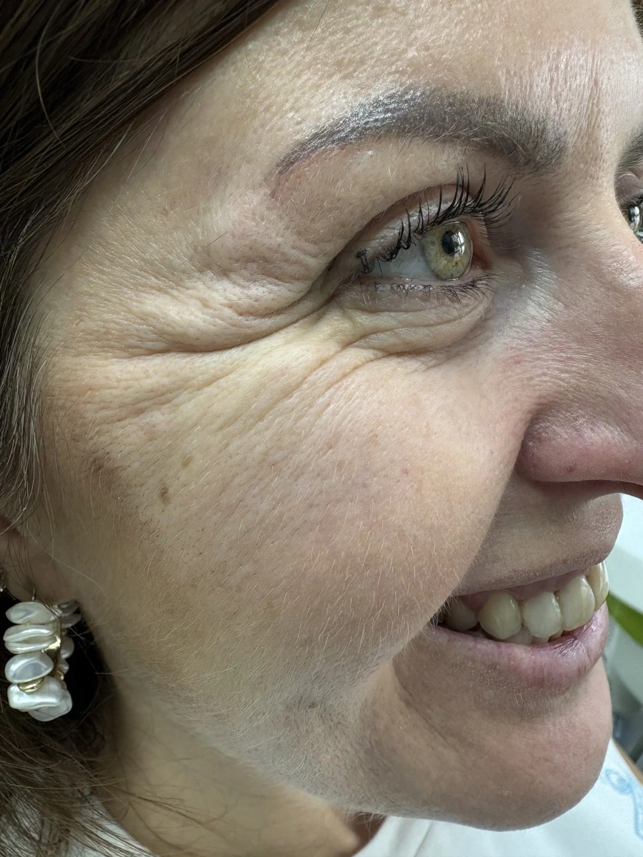 поставяне на ботокс - Reservation.Studio поставяне на ботокс - Reservation.Studio