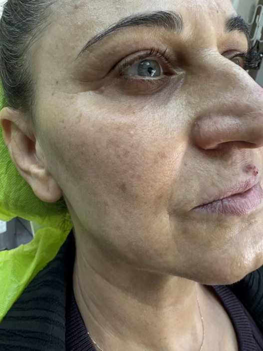 поставяне на филър поставяне на филър