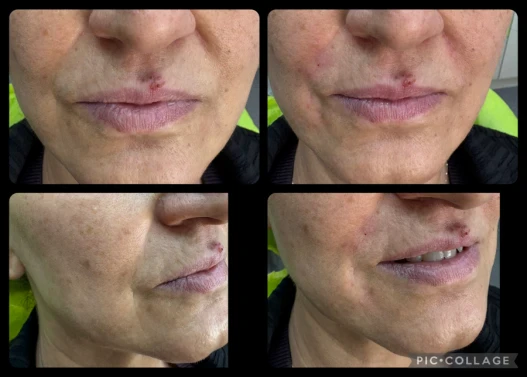 поставяне на филър поставяне на филър