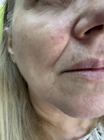 поставяне на филър