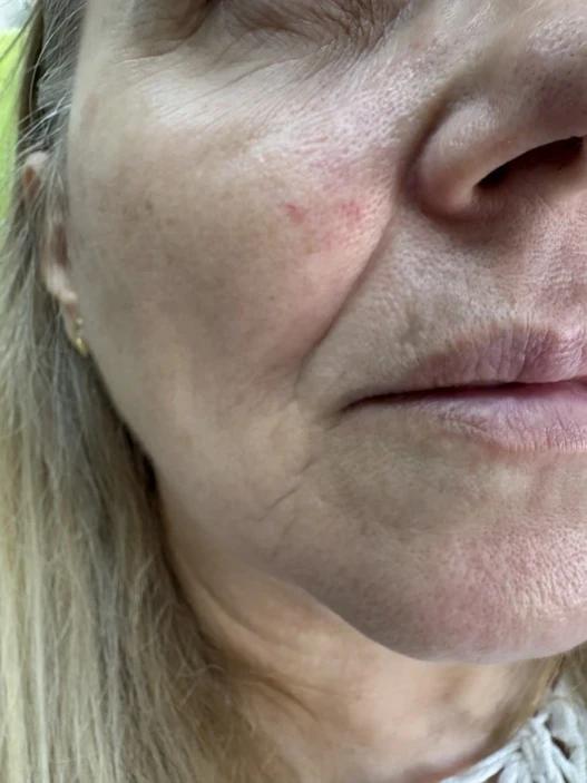 поставяне на филър