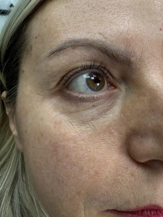 Поставяне на колагеностимулиращ филър/HArmoniCA,Ellanse,Juvelook,Lenisna