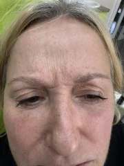 поставяне на ботокс поставяне на ботокс