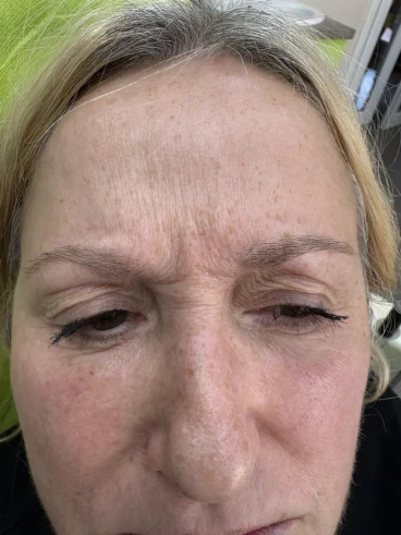 поставяне на ботокс