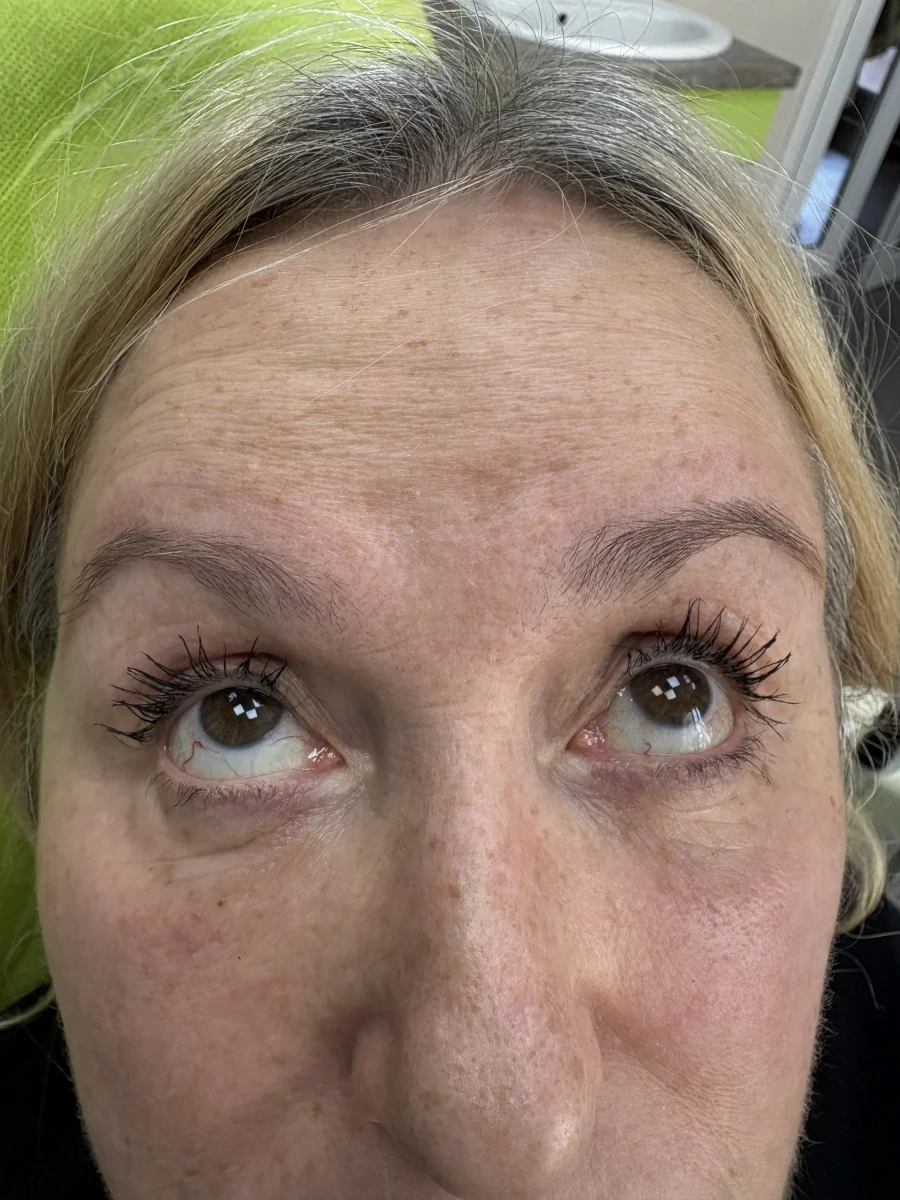 поставяне на ботокс - Reservation.Studio