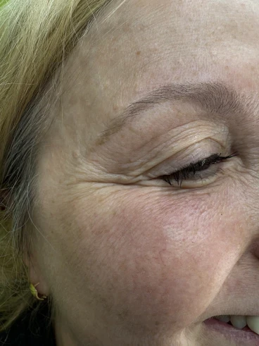 поставяне на ботокс поставяне на ботокс