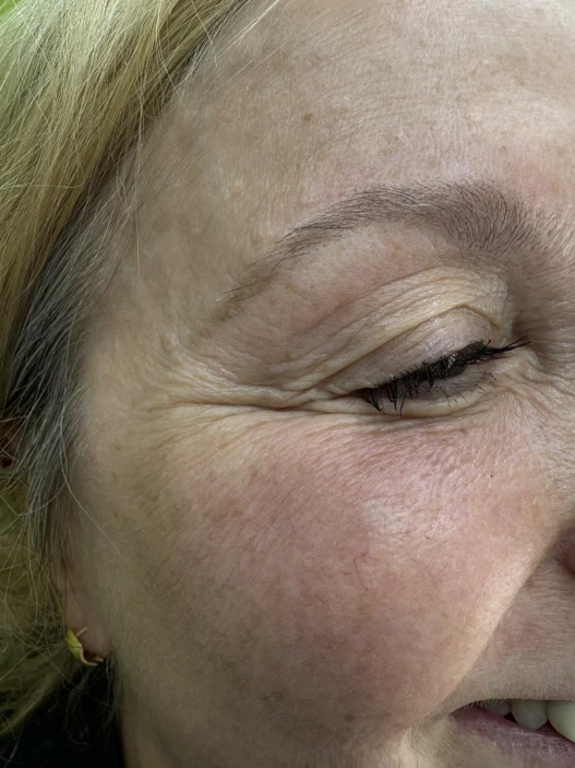 поставяне на ботокс