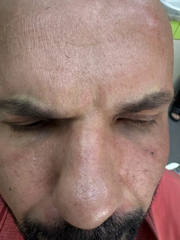 поставяне на ботокс поставяне на ботокс