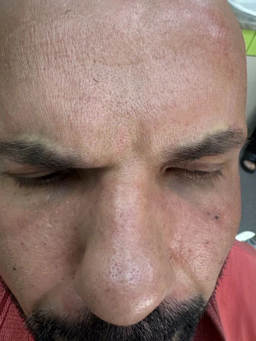 поставяне на ботокс поставяне на ботокс