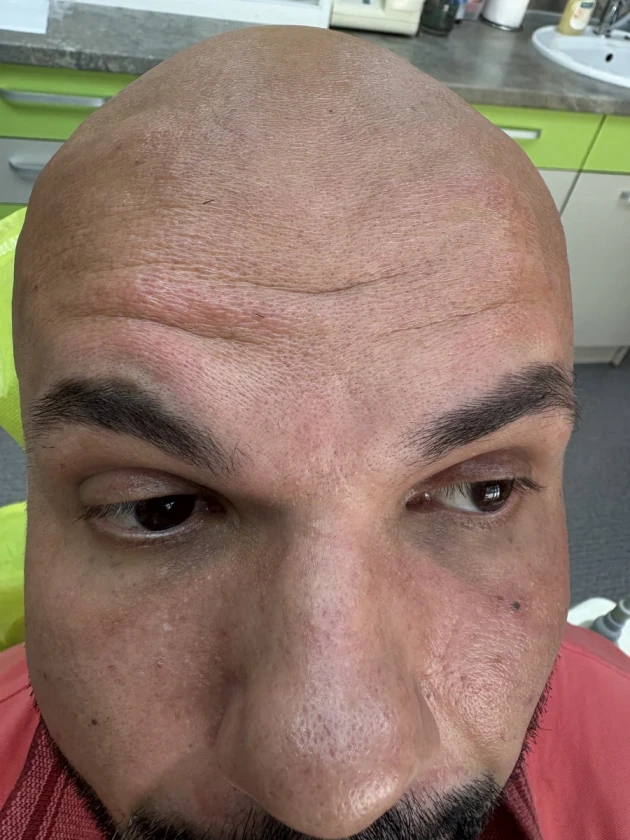 поставяне на ботокс - Reservation.Studio