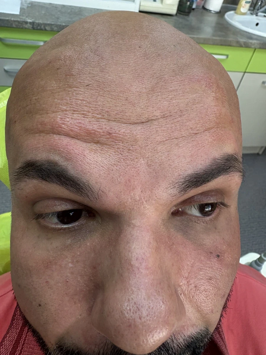 поставяне на ботокс - Reservation.Studio