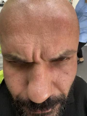 поставяне на ботокс поставяне на ботокс