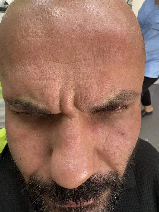 поставяне на ботокс поставяне на ботокс