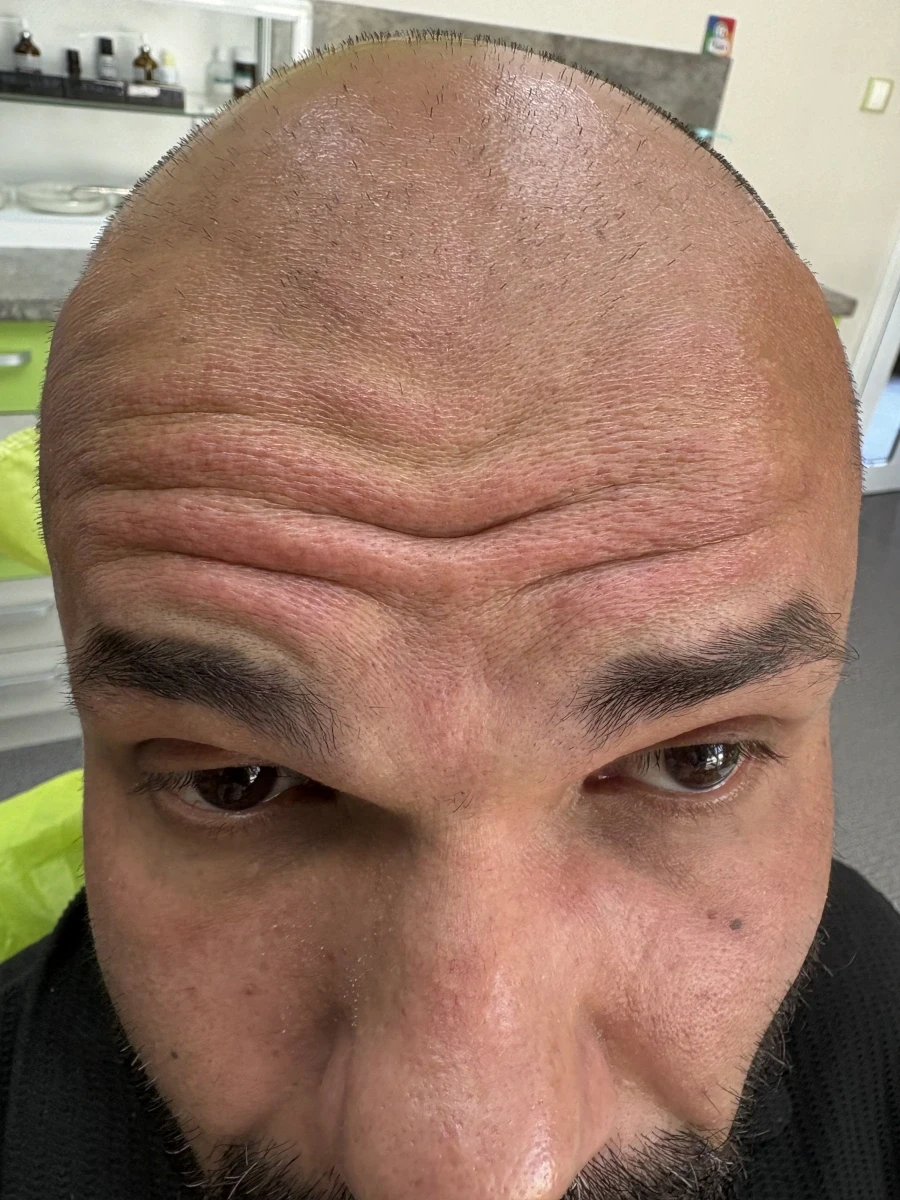 поставяне на ботокс - Reservation.Studio