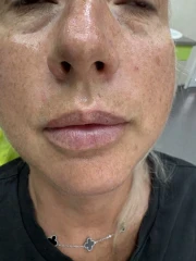 поставяне на филър поставяне на филър