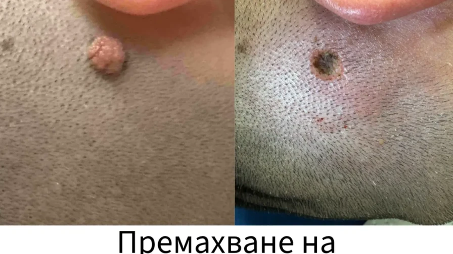 ⚡️ Отстраняване на фиброми, милиуми, брадавици, ксантелазми и др. с PlexR Pro ⚡️ Отстраняване на фиброми, милиуми, брадавици, ксантелазми и др. с PlexR Pro