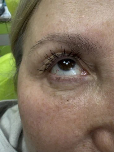 Поставяне на колагеностимулиращ филър/HArmoniCA,Ellanse,Juvelook,Lenisna Поставяне на колагеностимулиращ филър/HArmoniCA,Ellanse,Juvelook,Lenisna