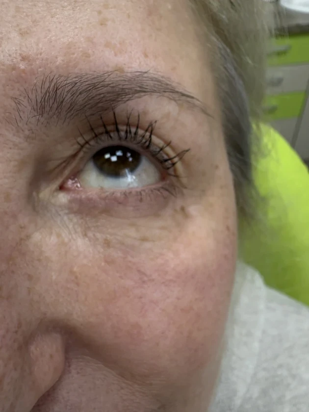 Поставяне на колагеностимулиращ филър/HArmoniCA,Ellanse,Juvelook,Lenisna - Reservation.Studio