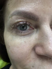 Поставяне на колагеностимулиращ филър/HArmoniCA,Ellanse,Juvelook,Lenisna