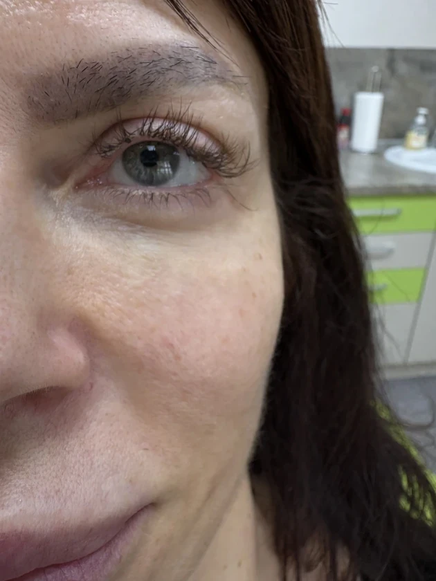 Поставяне на колагеностимулиращ филър/HArmoniCA,Ellanse,Juvelook,Lenisna - Reservation.Studio