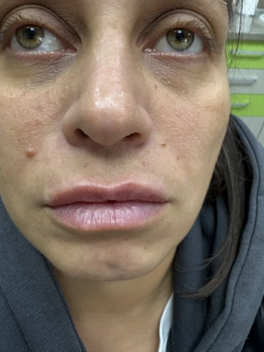 поставяне на филър поставяне на филър