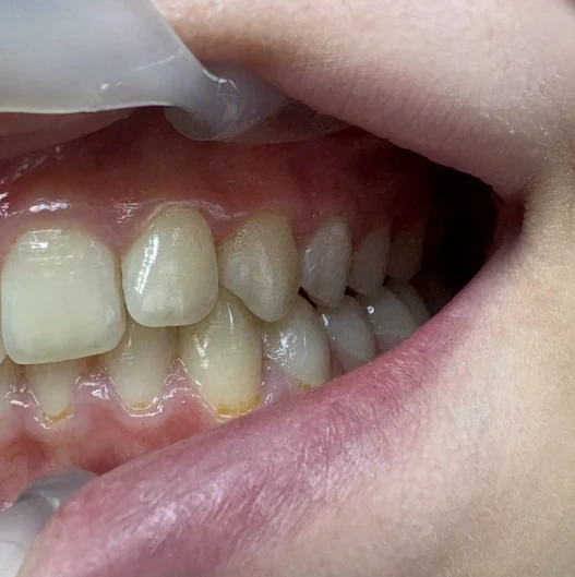 Стрипинг Стрипинг