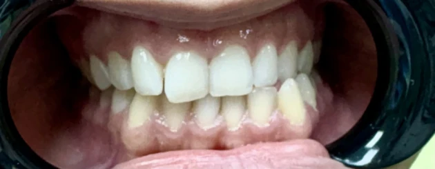 отпечатък за алайнери - Reservation.Studio отпечатък за алайнери - Reservation.Studio