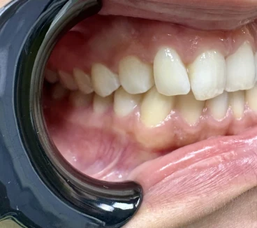 отпечатък за алайнери отпечатък за алайнери