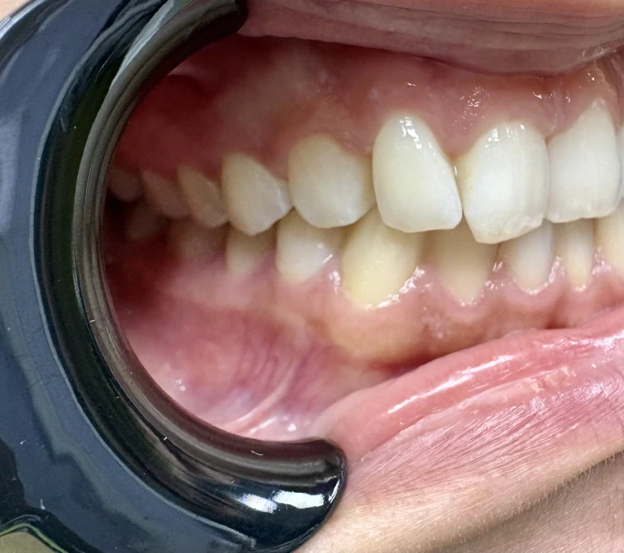 отпечатък за алайнери - Reservation.Studio отпечатък за алайнери - Reservation.Studio