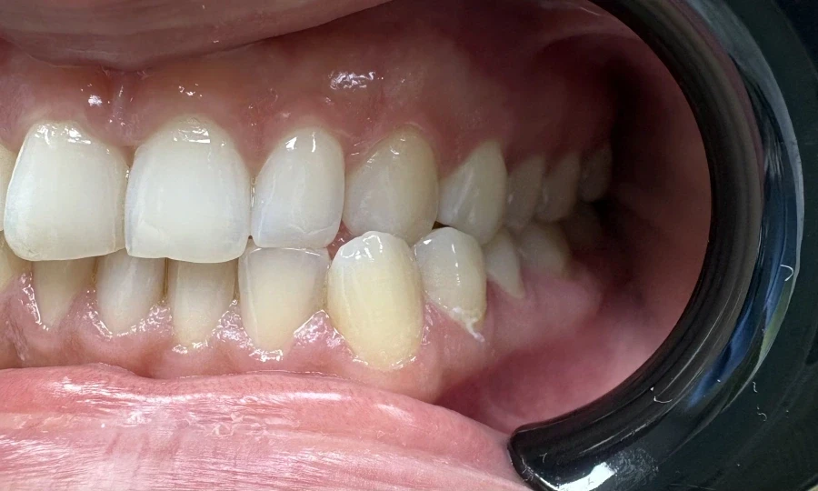 отпечатък за алайнери - Reservation.Studio