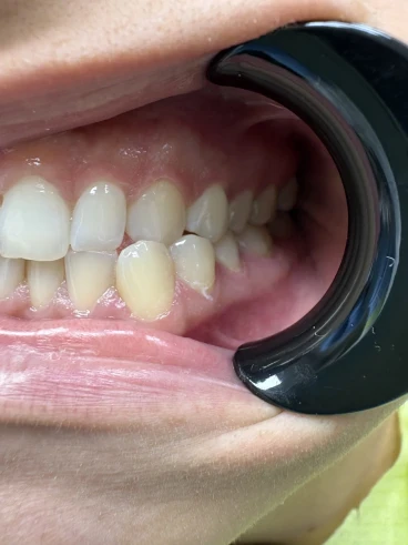 отпечатък за алайнери