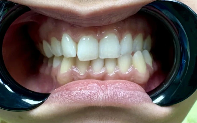 отпечатък за алайнери - Reservation.Studio