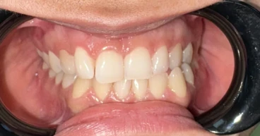 отпечатък за алайнери отпечатък за алайнери