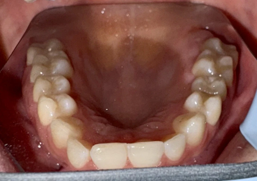 отпечатък за алайнери - Reservation.Studio отпечатък за алайнери - Reservation.Studio