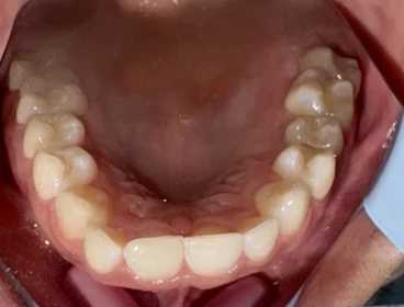 отпечатък за алайнери отпечатък за алайнери