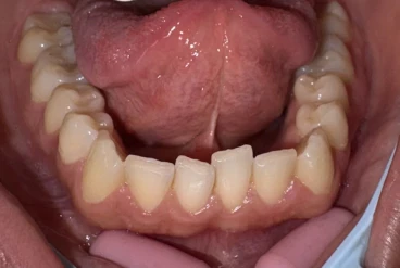 отпечатък за алайнери отпечатък за алайнери