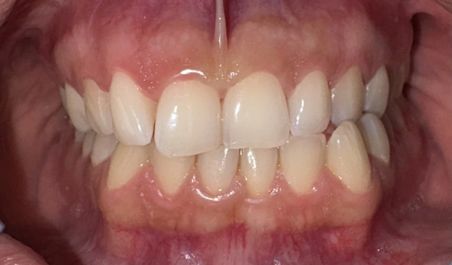 отпечатък за алайнери - Reservation.Studio отпечатък за алайнери - Reservation.Studio