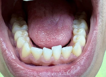 отпечатък за алайнери отпечатък за алайнери