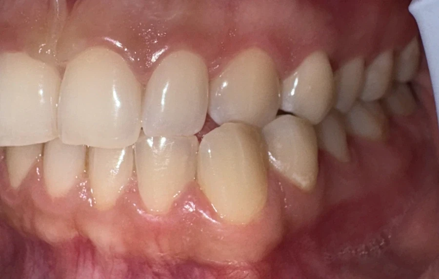 отпечатък за алайнери - Reservation.Studio отпечатък за алайнери - Reservation.Studio